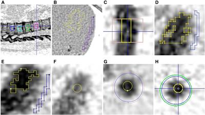 A systematic evaluation of five different image-derived input functions for the clinical implementation of 18F-NaF bone PET/CT in patients with chronic kidney disease–mineral and bone disorder